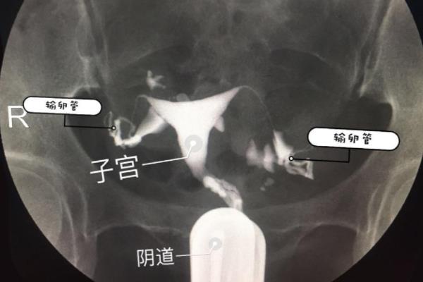 輸卵管造影檢查痛苦嗎