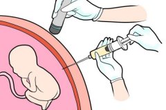 孕期多少周可以做絨毛穿刺？做了還需要做唐篩嗎
