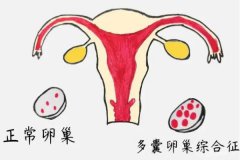 多囊卵巢可以懷孕嗎？多囊卵巢懷孕后易流產嗎？
