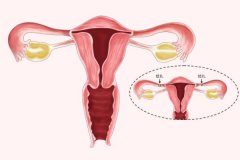 剖腹產結扎可以做復通術嗎？結扎復通術要開刀嗎？