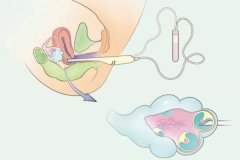 取一個卵子有成功的嗎？取卵多少個算正常？