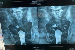 輸卵管造影檢查后要休息多久?檢查了輸卵管什么時候能懷孕?
