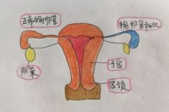 輸卵管積水癥狀是什么？還能做試管嬰兒嗎？