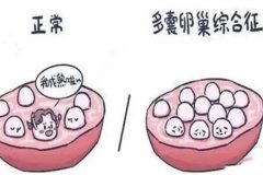 多囊卵巢綜合征是什么原因引起的？會不會遺傳？