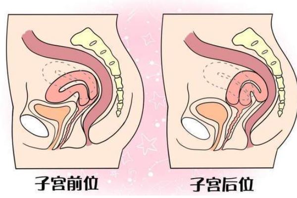子宮后位懷孕成功幾率有多少？子宮后位是什么原因引起的？